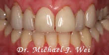 case 22 before porcelain veneers, tooth colored fillings